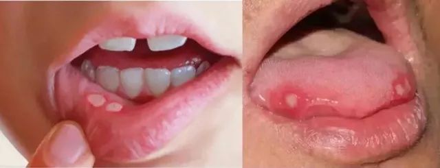 口腔溃疡10秒止疼草药,一秒止痛口腔溃疡