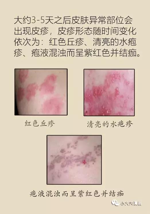 协和医院可以打带状疱疹疫苗吗,协和医院带状疱疹专家