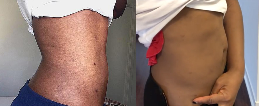 吸脂减肥前后对比图片,吸脂减肥全部过程视频术后