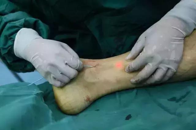 景德镇市第一人民医院开展全市首例大隐静脉曲张激光治疗术