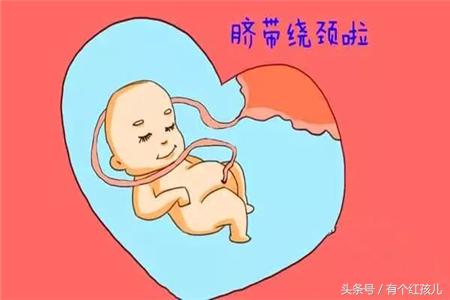 怎么预防宝宝脐带绕颈,预防脐带绕颈
