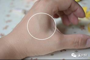 像蚯蚓一样的凸起的纹,像蚯蚓一样黑色的是什么