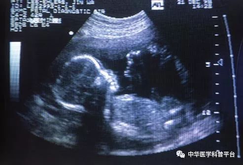 精神分裂症的表现,精神分裂症