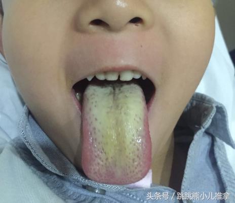 怎么看宝宝舌头是否积食,宝宝积食的舌头是怎样的
