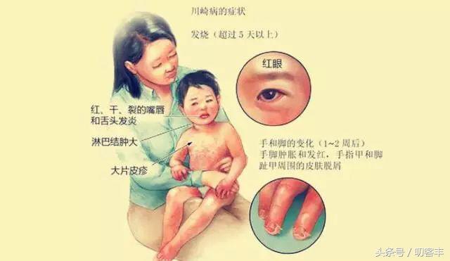 川崎病是皮肤黏膜淋巴结综合征么,川崎病血管炎多久治好