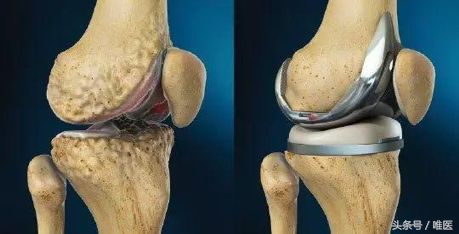 膝盖长期痛怎么办,膝盖痛有什么好方法治疗