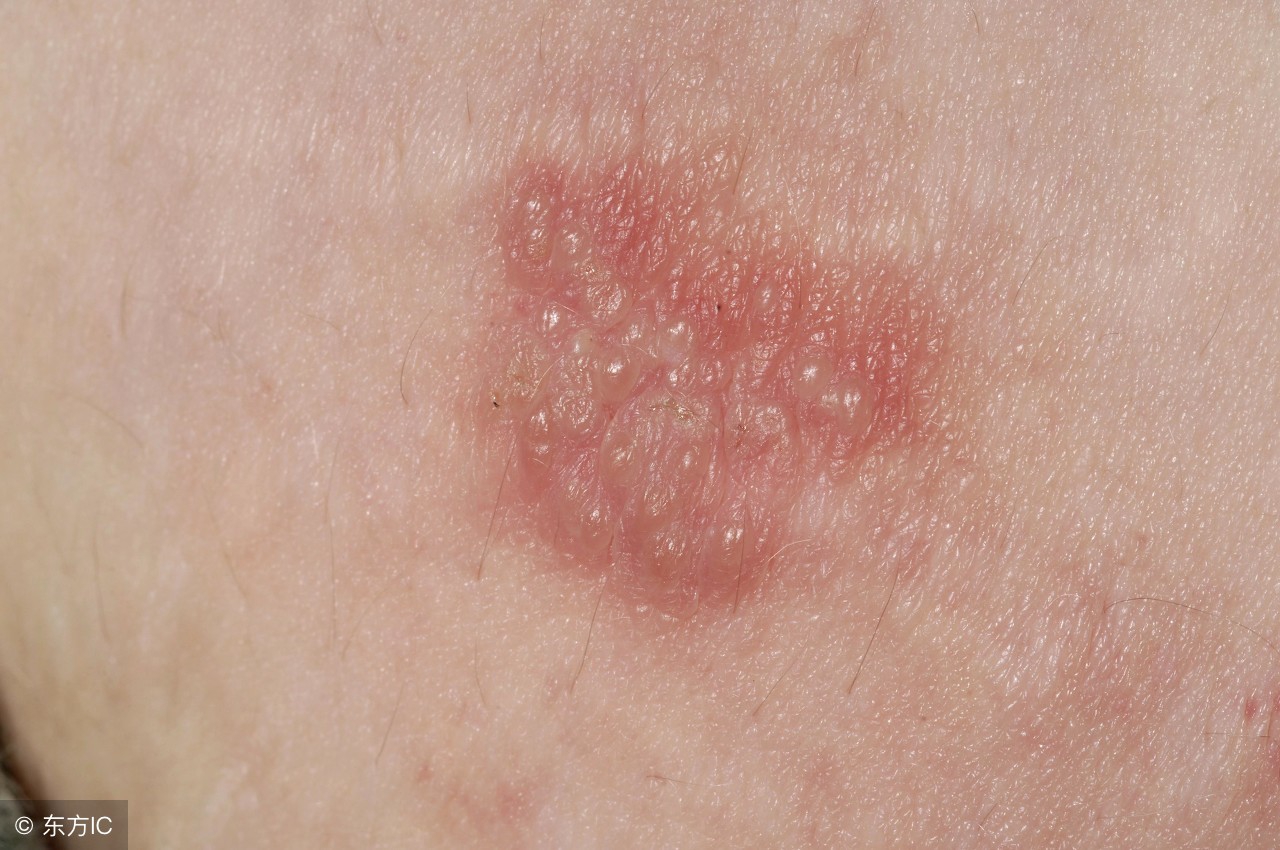 巨细胞和单纯疱疹病毒如何预防,单纯疱疹病毒hsv1型是怎么感染的