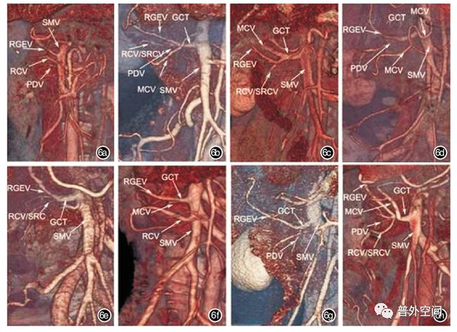 腹腔镜完整结肠系膜切除术相关血管变异与术中出血的应对措施(上)