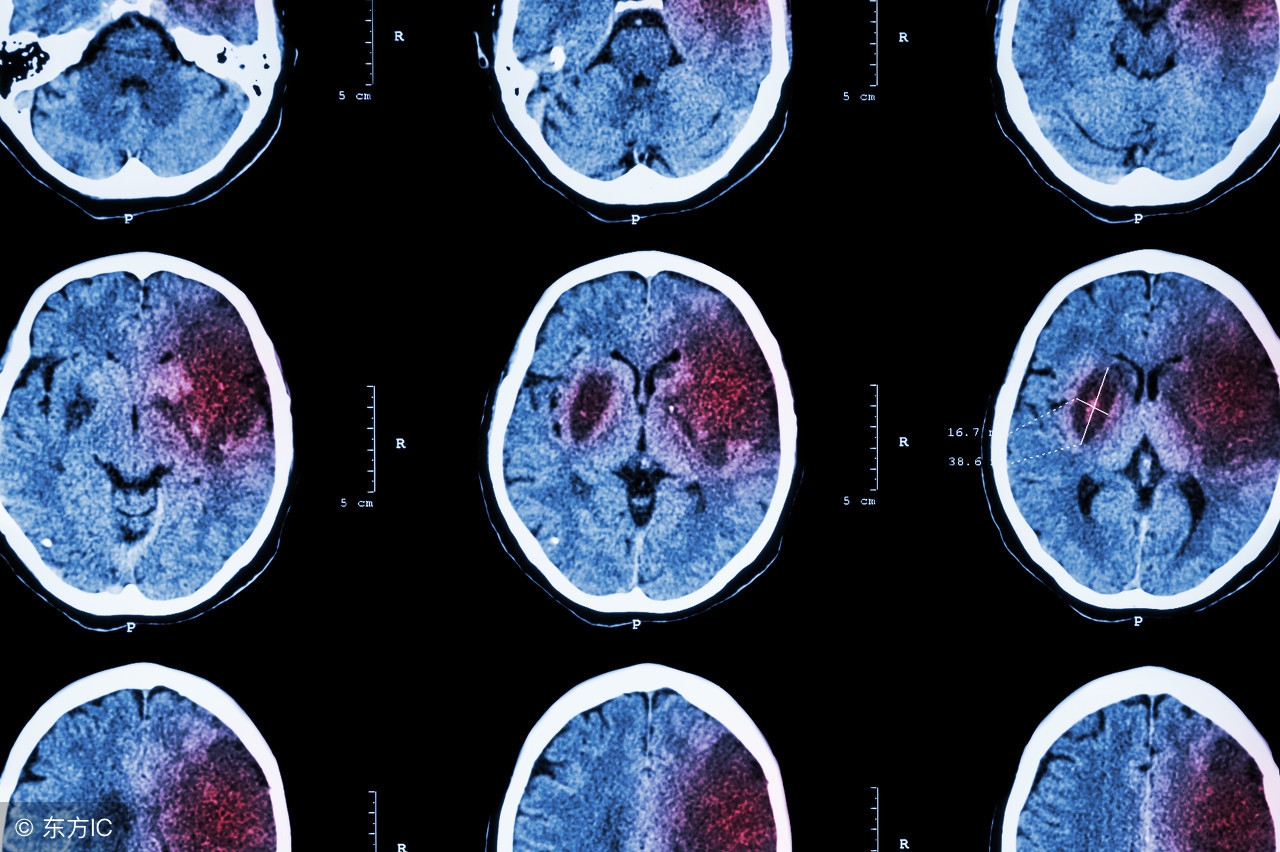 小中风是中风前兆吗,小中风从中医角度看是什么引起的