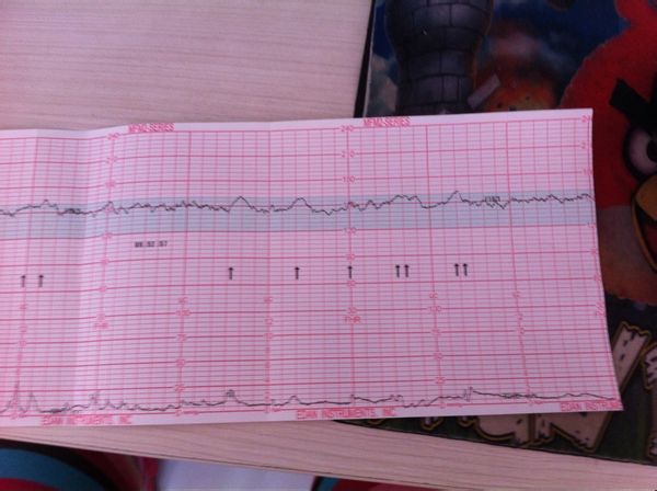孕期胎心比较弱如何养护,胎心监护有时候异常怎么回事