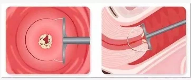 leep手术会导致子宫内膜变薄吗,leep手术为啥没有填塞纱布