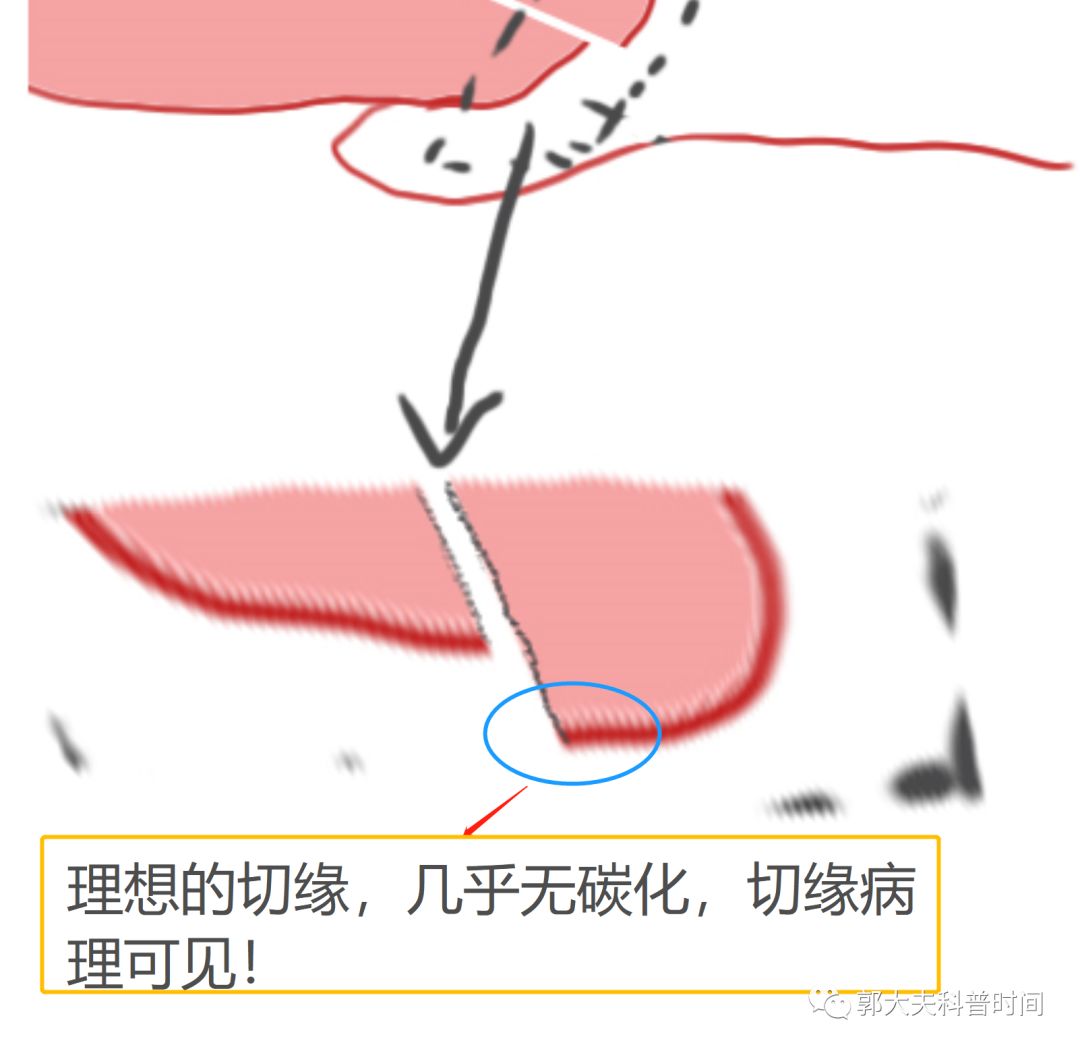 leep手术会导致子宫内膜变薄吗,leep手术为啥没有填塞纱布