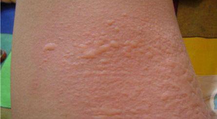 宝妈容易长痱子,宝妈长痱子