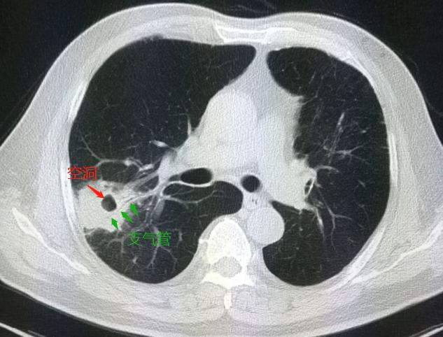 肺部3厘米的肿块是肺癌早期吗,肺上长出30cm肿块应该怎么办