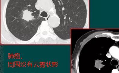 肺上肿块,肺上长出30cm肿块应该怎么办