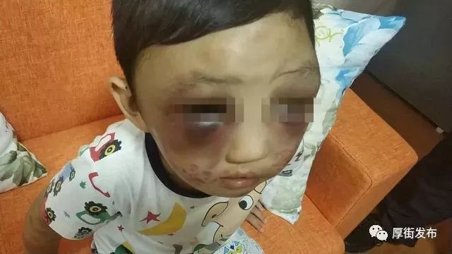 十岁男孩遭母亲毒打遍体鳞伤,四岁男童被亲妈打后续