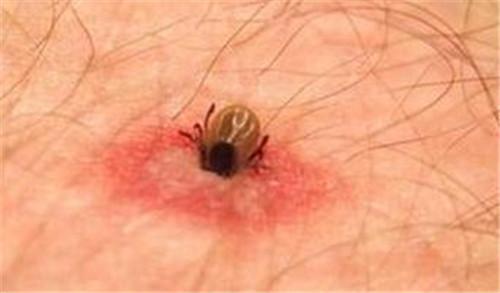 草爬子咬小孩,草爬子叮咬