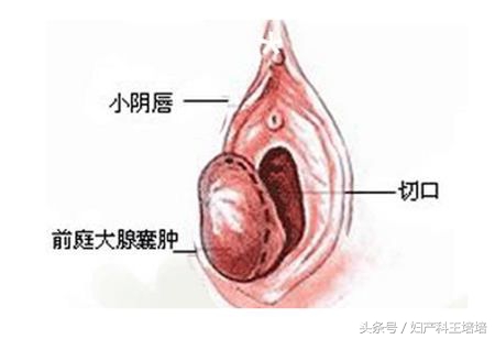 关于前庭大腺囊肿的成因,关于前庭大腺囊肿的正确描述