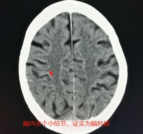 头晕、手麻，不是脑血栓，是肺癌脑转移？豪大夫讲肺结节（三）