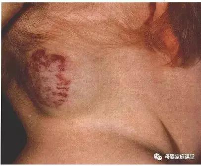 红色血管瘤胎记能彻底治愈吗,宝宝红色胎记需要治疗吗