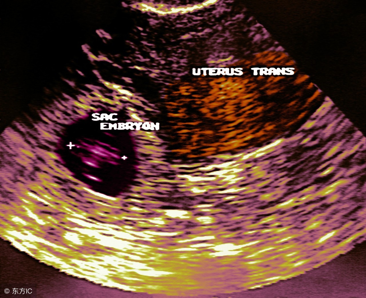 宫外孕引起的原因和男士有关系吗,宫外孕腿好胀好酸是什么原因