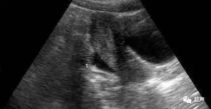 怎么分清盆腔积液是生理还是病理,盆腔积液怎么区分生理性和病理性