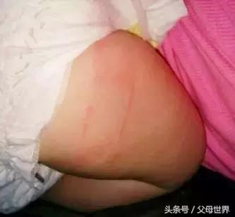 宝宝受伤用什么创可贴,宝宝受伤可以用创口贴吗