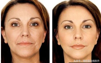 脸部肌肉下垂怎样变得紧致医美,脸部肌肉下垂怎么办