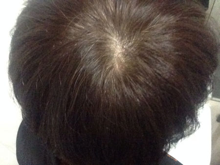 人头发后面都有个旋吗,每个人头顶都有旋么