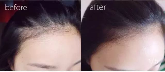 脱发、发际线高、地中海的克星！用它，1个月头发不掉了，不痒了，半年变浓密
