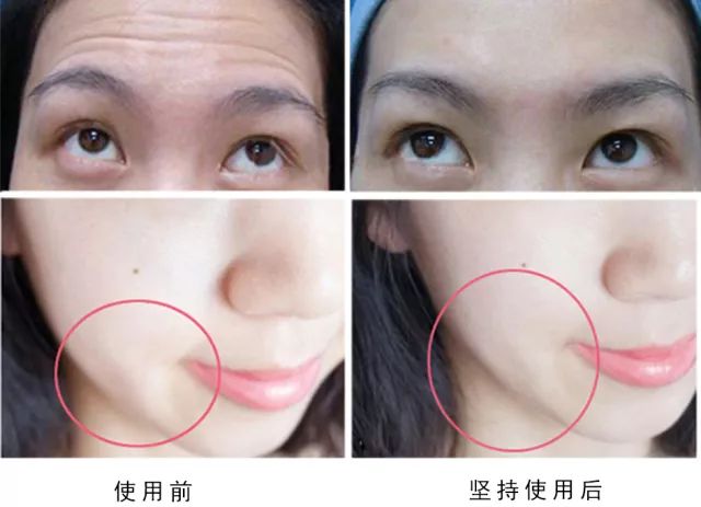 不用针提拉紧致皮肤的机器,冻龄防早衰精华乳