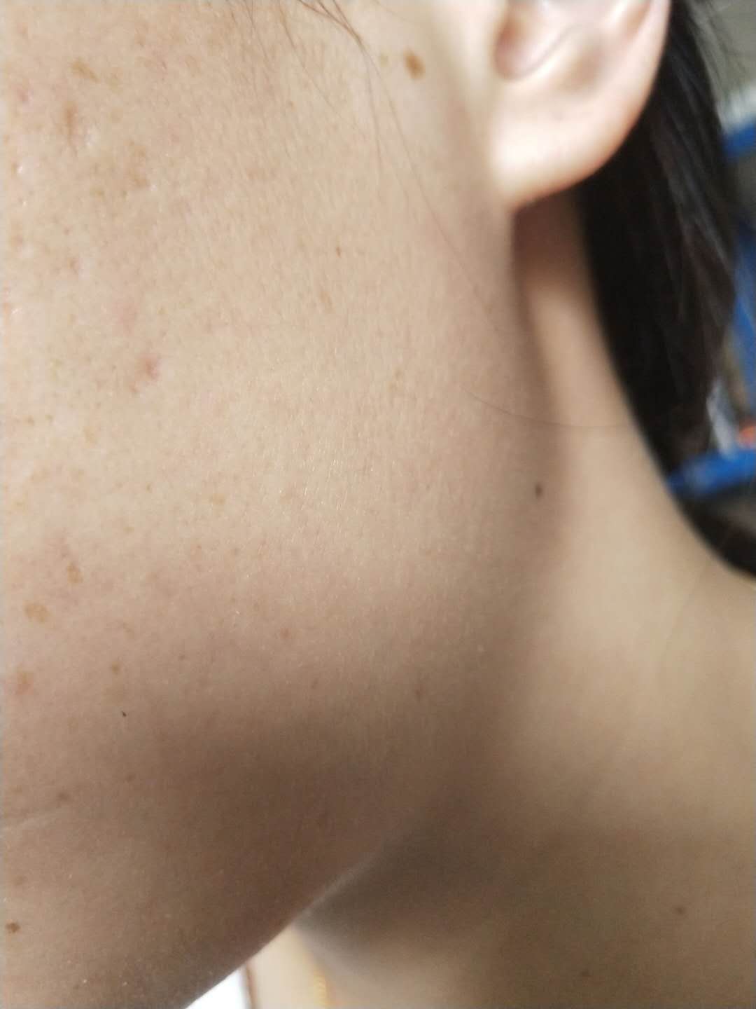 祛额头痘痘和痘印小妙招学生党,去痘痘痘印方法简便