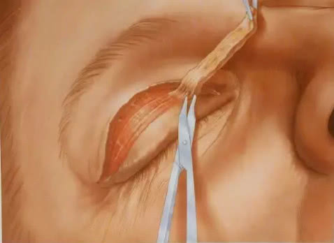 双眼皮手术过程中有烧焦味,埋线定位无痕双眼皮手术过程