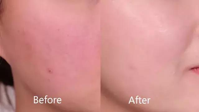 困扰好几年的痘痘终于好了,困扰多年痘痘终于好了