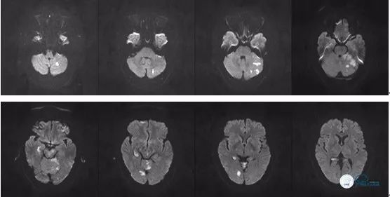 基底动脉闭合手术,基底动脉闭塞取栓一直昏睡