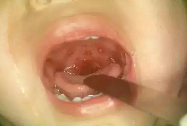 怎么区分水痘与手足口病,疱疹性咽峡炎和手足口病如何分别