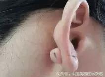 为什么打耳洞臭臭的,刚打的耳洞流黄水臭臭的怎么办