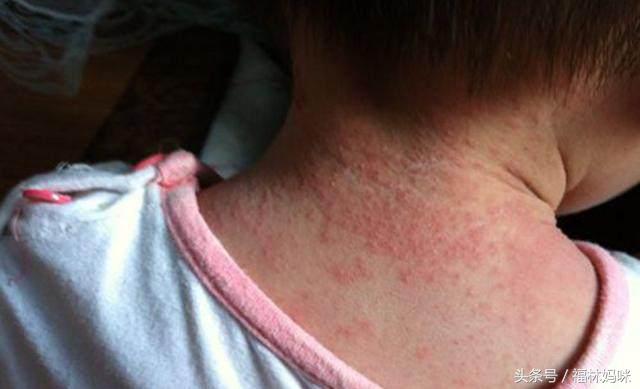 宝宝湿疹和痱子怎么区别,宝宝得了湿疹痱子解决方法