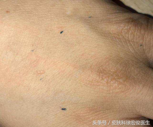 皮脂腺增生和扁平疣的区别,老人脸上长了很多扁平疣