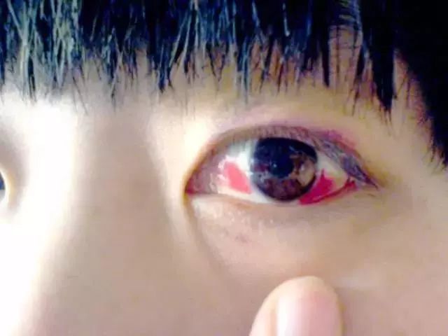 眼干眼涩按摩眼部有用吗,眼干眼涩用食疗怎么调理