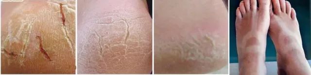 擦掉一张皮，双脚换皮术！死皮、老茧一喷就没，15秒还原嫩白玉足