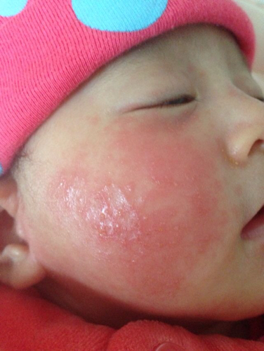 容易长湿疹教你3个方法赶走湿疹,宝宝湿疹快速消除小窍门