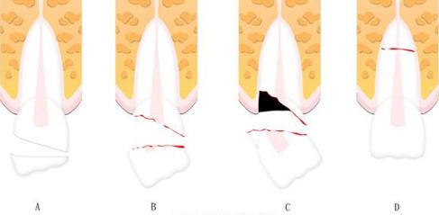 怎么拯救牙齿最快最有效,如何拯救牙齿