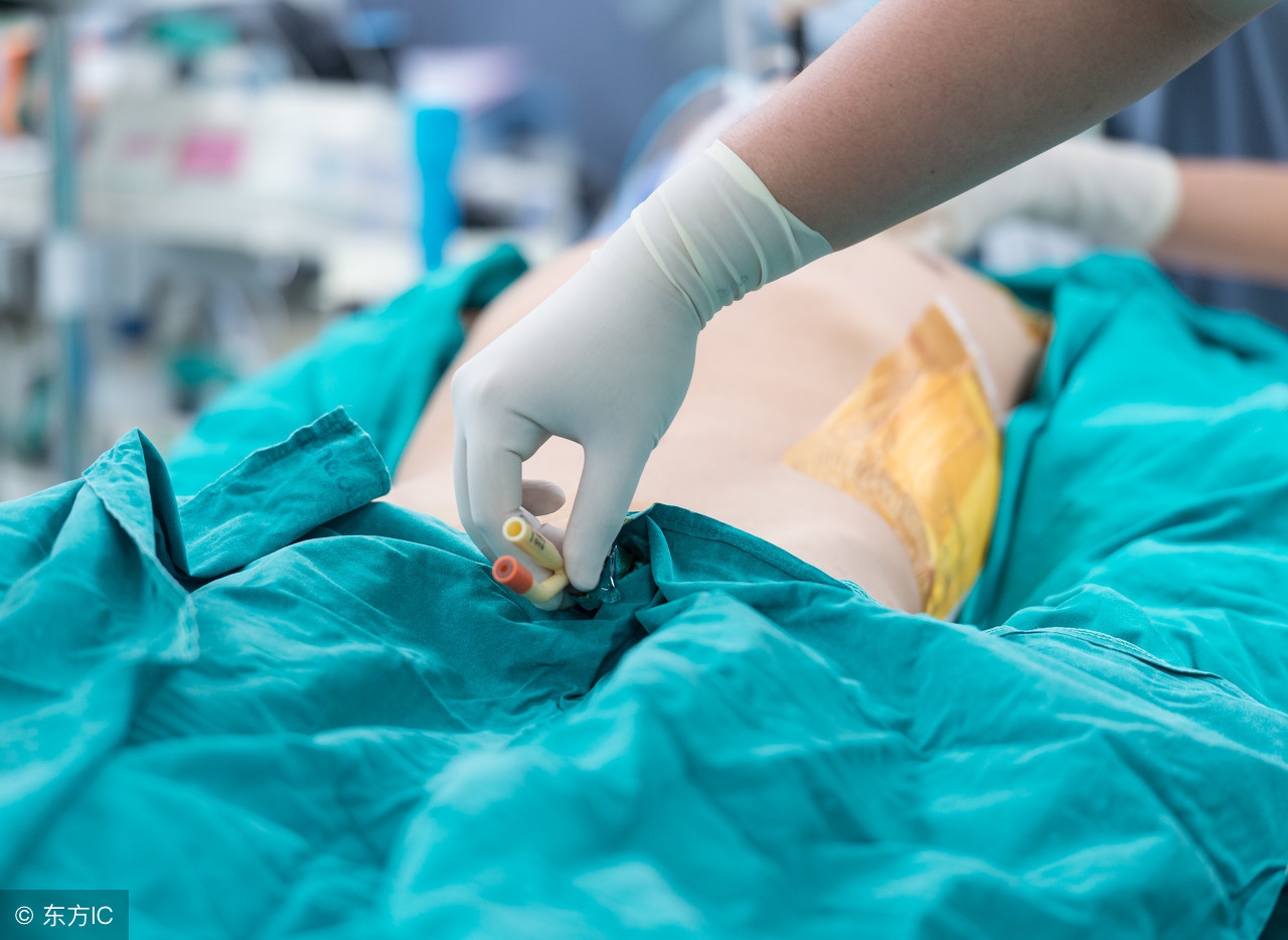 前列腺摘除术后膀胱冲洗注意事项,膀胱结石后冲洗要注意什么