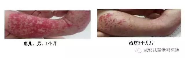 后脑勺红色印记是胎记还是血管瘤,皮肤有红色印记是血管瘤还是胎记