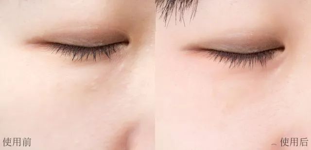 不用针挑手指扎进刺了怎么办,不用针挑就能挑出刺的方法