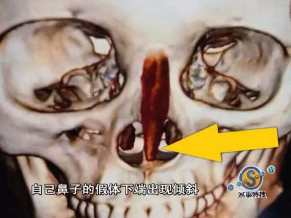 女子花9万元整容结果,女子花费9万多元整容整成歪鼻子