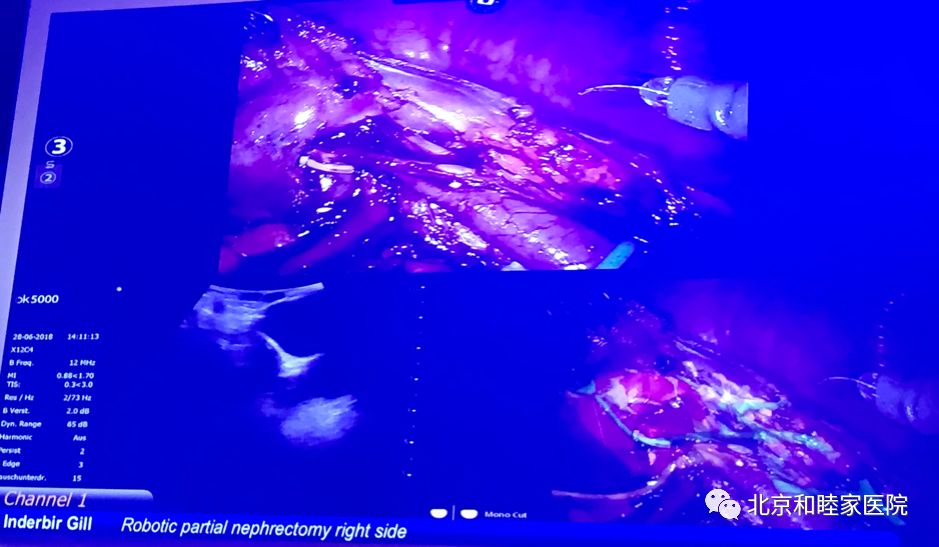 科普大赛腹腔镜手术机器人,腹腔镜及机器人手术