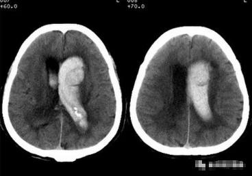 脑出血分期及影像学表现,脑出血各个部位的临床表现