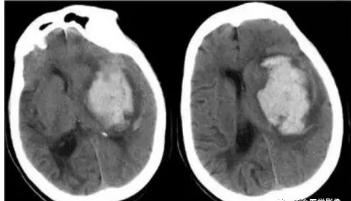 脑出血分期及影像学表现,脑出血各个部位的临床表现